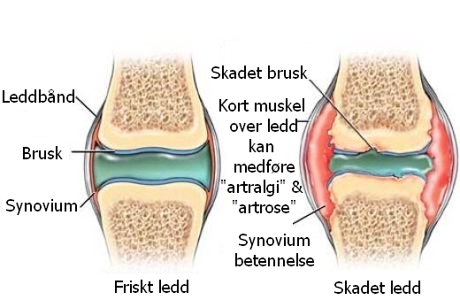 muskelsyndrom